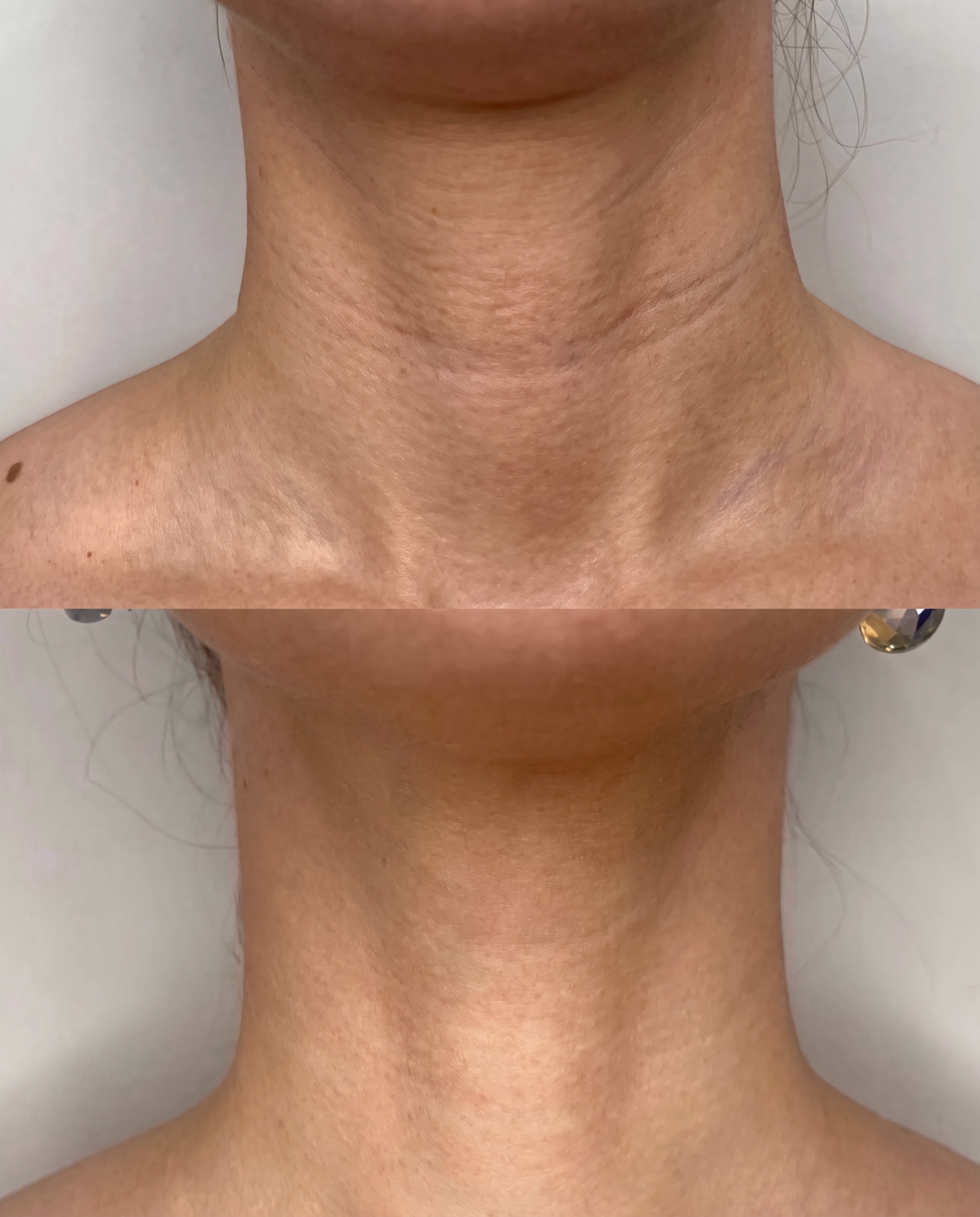 Hals und Dekolleté einer Kundin vor und nach dem RF-Needling